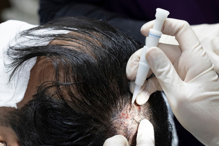 Hair Transplant Turkey: Transform Your Look with Confidence