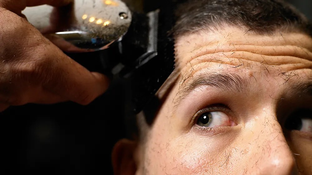 Hair Transplant Istanbul – Advanced Techniques for Hair Growth