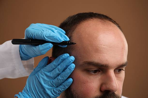 Hair Transplant Price in Istanbul: Best Value for Patients