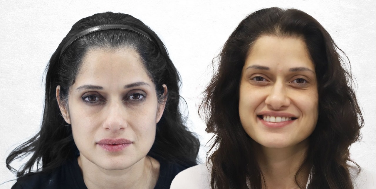 Affordable Hair Transplant UK – Quality You Can Trust